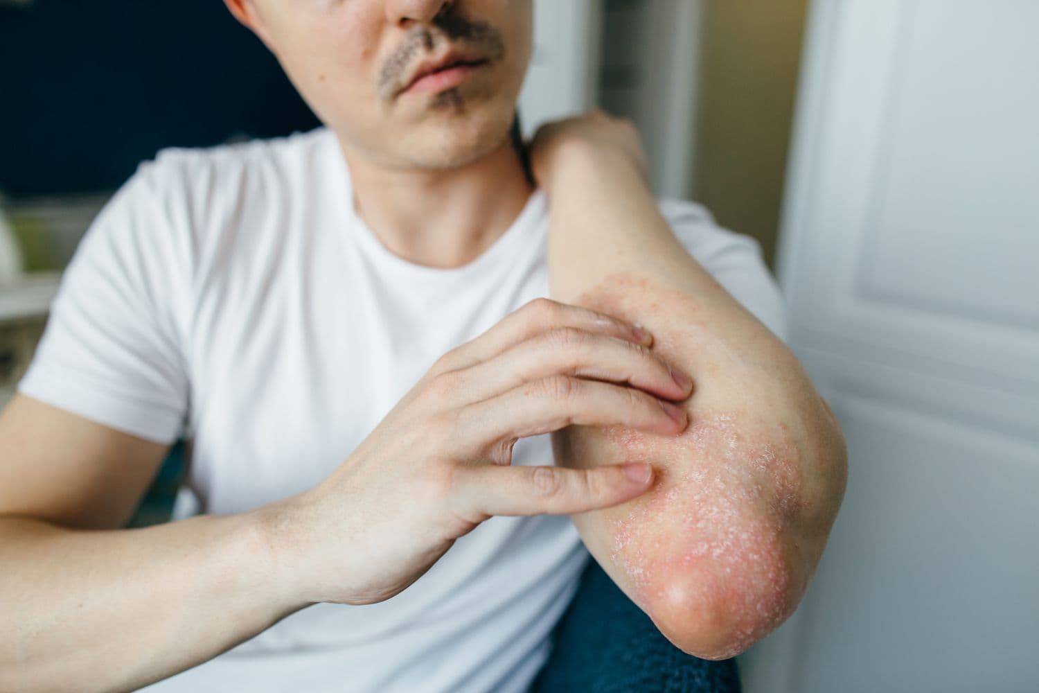 Can you get eczema as an adult?